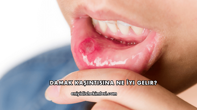 Damak Kaşıntısına Ne İyi Gelir?