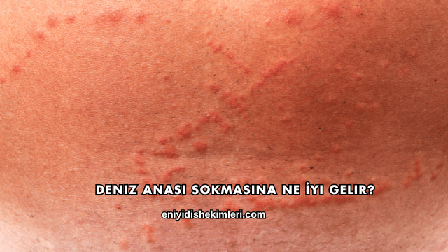 Deniz Anası Sokmasına Ne İyi Gelir?