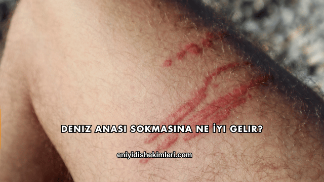 Deniz Anası Sokmasına Ne İyi Gelir?