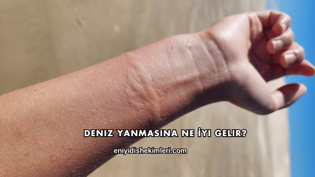 Deniz Yanmasına Ne İyi Gelir?