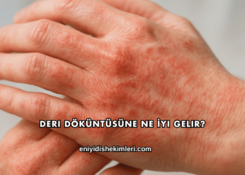 Deri Döküntüsüne Ne İyi Gelir?