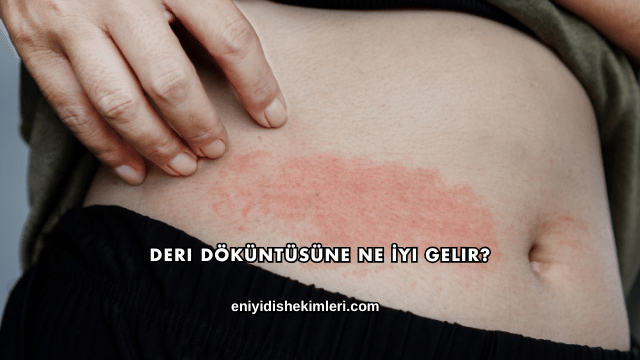 Deri Döküntüsüne Ne İyi Gelir?