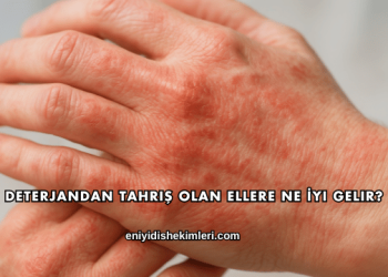 Deterjandan Tahriş Olan Ellere Ne İyi Gelir?