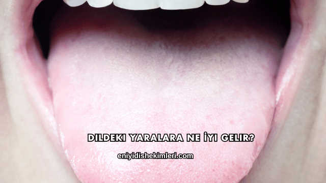 Dildeki Yaralara Ne İyi Gelir?