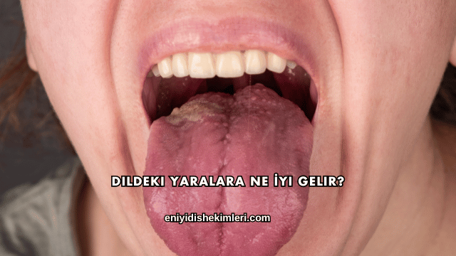 Dildeki Yaralara Ne İyi Gelir?