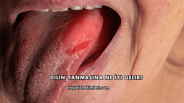 Dilin Yanmasına Ne İyi Gelir?
