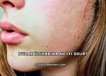 Dudak İltihabına Ne İyi Gelir?