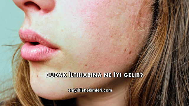 Dudak İltihabına Ne İyi Gelir?