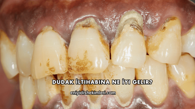 Dudak İltihabına Ne İyi Gelir?