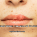 Dudak Kenarı Yarasına Ne İyi Gelir?