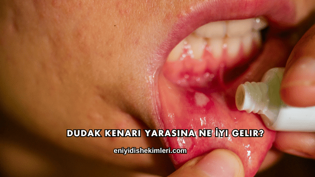 Dudak Kenarı Yarasına Ne İyi Gelir?