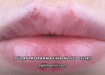 Dudak Morarmasına Ne İyi Gelir?