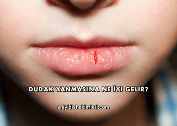 Dudak Yanmasına Ne İyi Gelir?