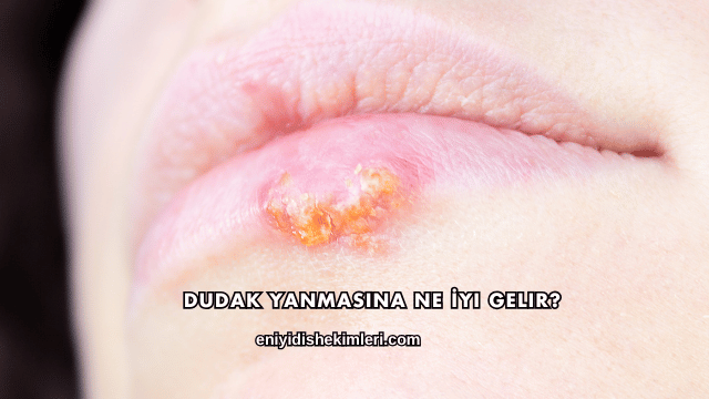 Dudak Yanmasına Ne İyi Gelir?