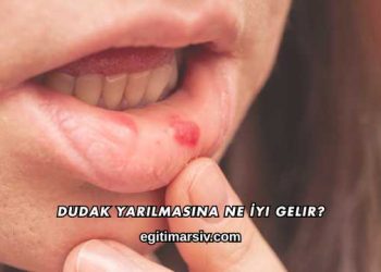 Dudak Yarılmasına Ne İyi Gelir?