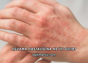 Egzama Hastalığına Ne İyi Gelir?