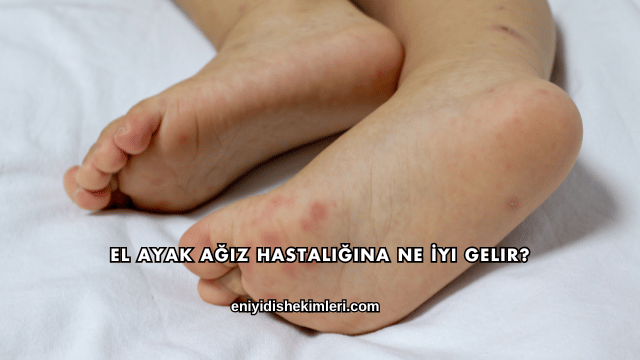 El Ayak Ağız Hastalığına Ne İyi Gelir?