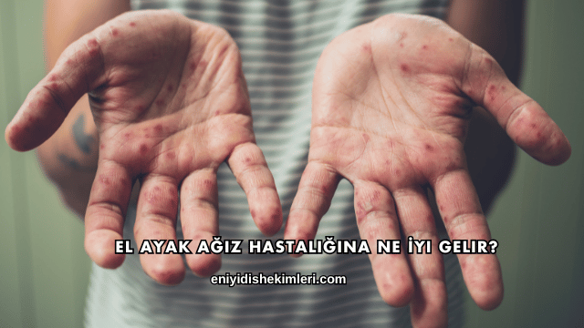 El Ayak Ağız Hastalığına Ne İyi Gelir?