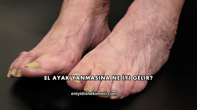 El Ayak Yanmasına Ne İyi Gelir?