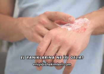El Yanıklarına Ne İyi Gelir?