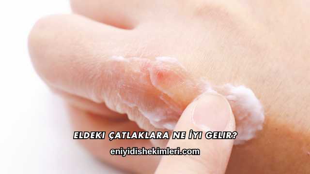 Eldeki Çatlaklara Ne İyi Gelir?