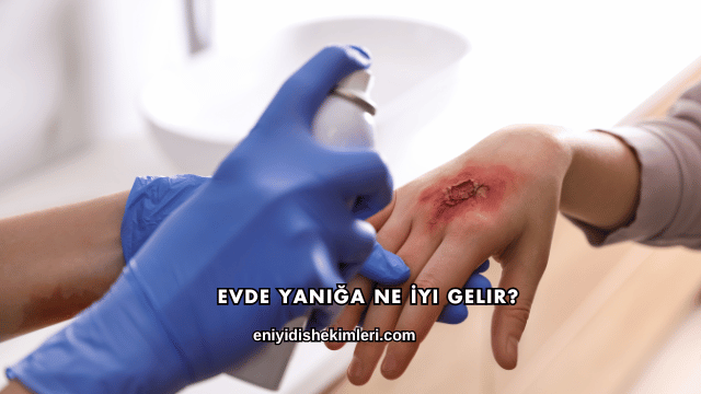 Evde Yanığa Ne İyi Gelir?