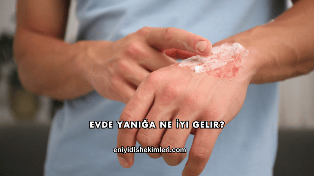 Evde Yanığa Ne İyi Gelir?