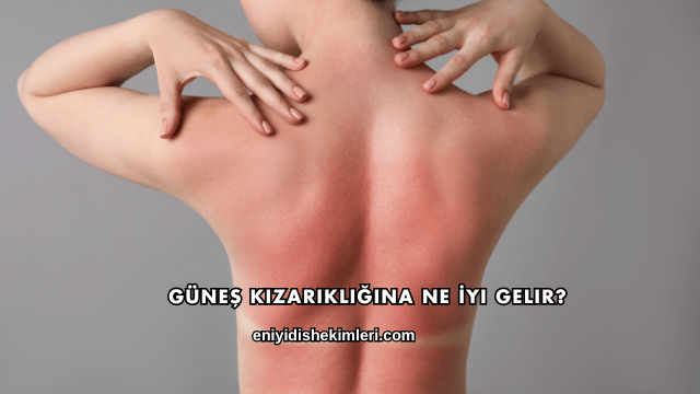 Güneş Kızarıklığına Ne İyi Gelir?