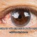 İltihaplı Göz Şişmesine Ne İyi Gelir?