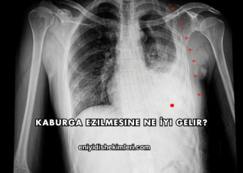 Kaburga Ezilmesine Ne İyi Gelir?
