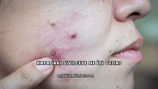 Kafadaki Sivilceye Ne İyi Gelir?