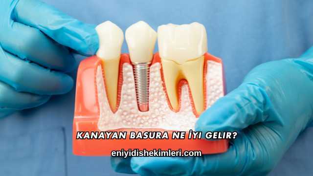 Kanayan Basura Ne İyi Gelir?