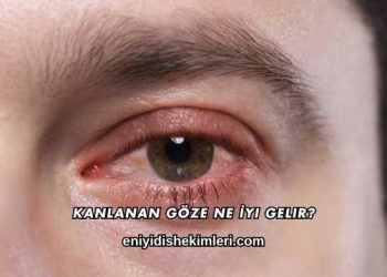 Kanlanan Göze Ne İyi Gelir?