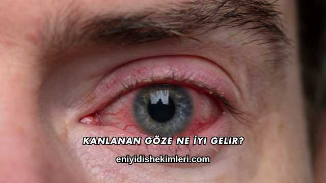 Kanlanan Göze Ne İyi Gelir?