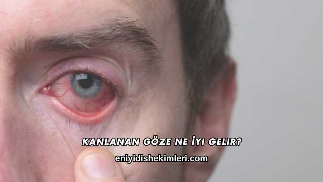 Kanlanan Göze Ne İyi Gelir?