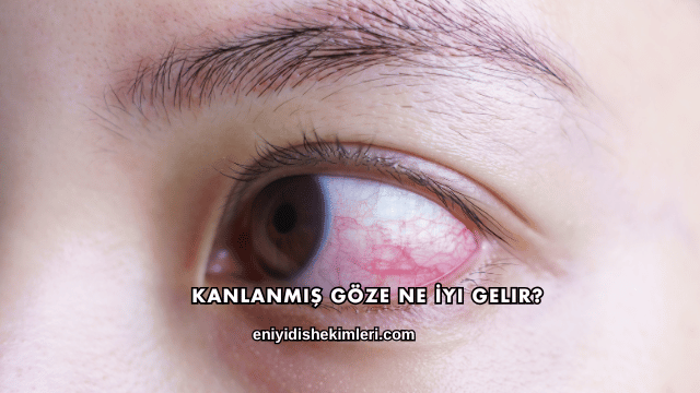 Kanlanmış Göze Ne İyi Gelir?