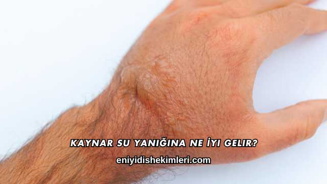 Kaynar Su Yanığına Ne İyi Gelir?