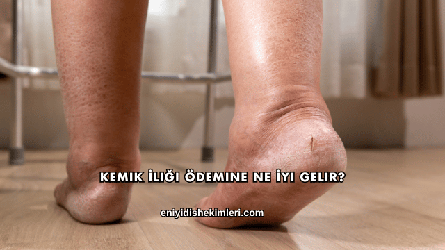 Kemik İliği Ödemine Ne İyi Gelir?
