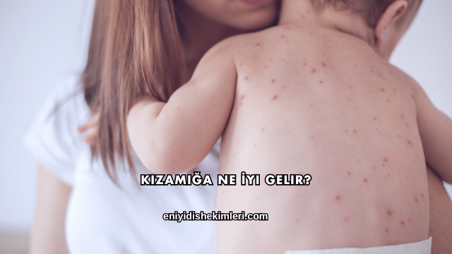 Kızamığa Ne İyi Gelir?