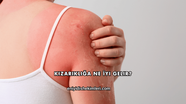 Kızarıklığa Ne İyi Gelir?