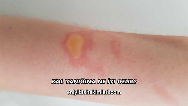 Kol Yanığına Ne İyi Gelir?