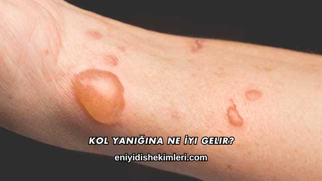 Kol Yanığına Ne İyi Gelir?