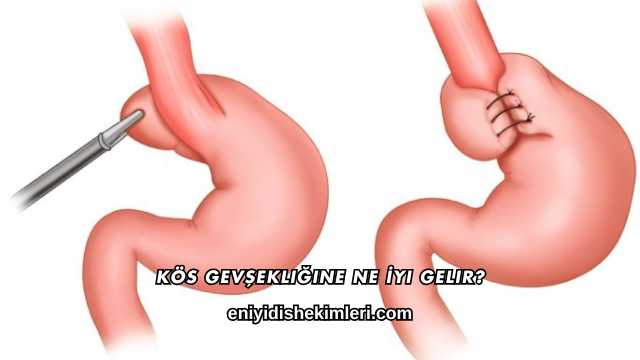 Kös Gevşekliğine Ne İyi Gelir?