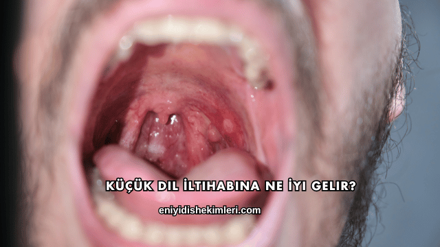 Küçük Dil İltihabına Ne İyi Gelir?