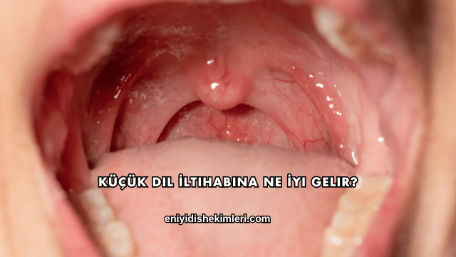 Küçük Dil İltihabına Ne İyi Gelir?