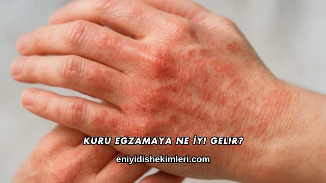 Kuru Egzamaya Ne İyi Gelir?