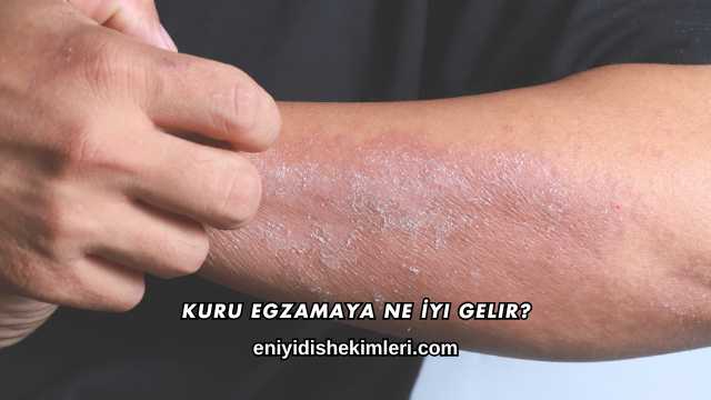 Kuru Egzamaya Ne İyi Gelir?