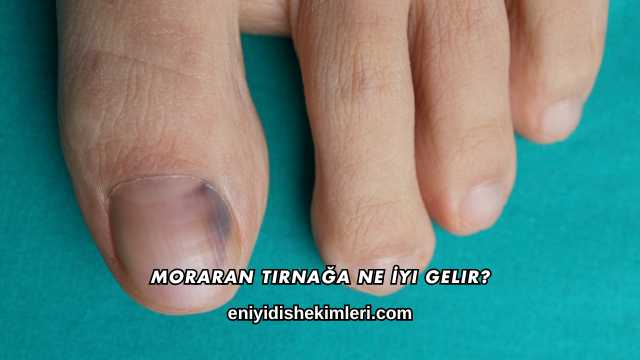 Moraran Tırnağa Ne İyi Gelir?