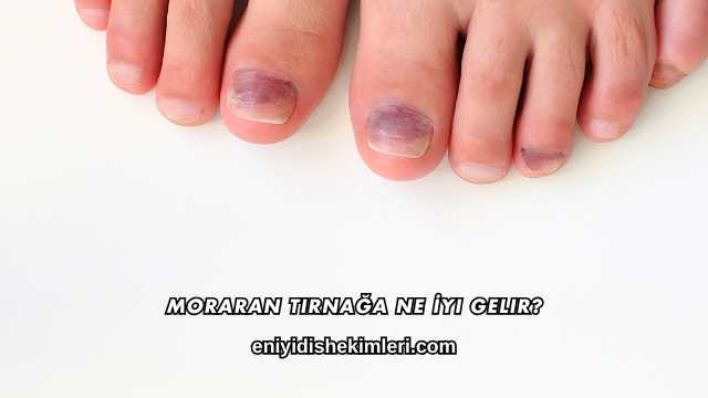 Moraran Tırnağa Ne İyi Gelir?