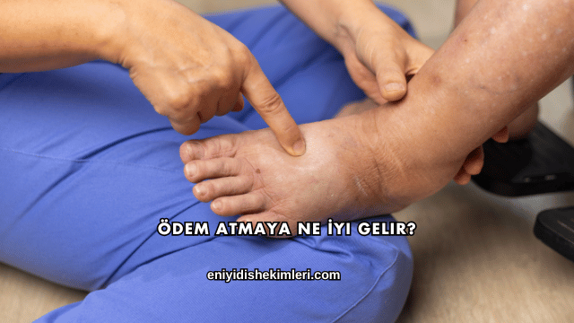 Ödem Atmaya Ne İyi Gelir?